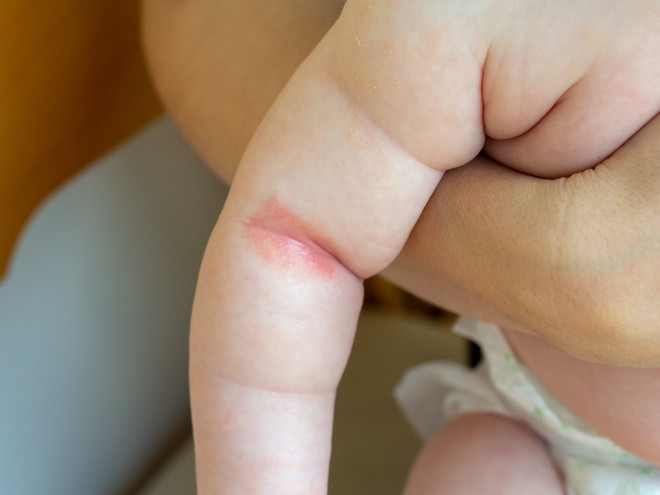 Симптомы и диагностика атопического дерматита у детей