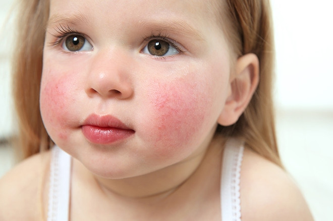Воспаление кожи у ребенка