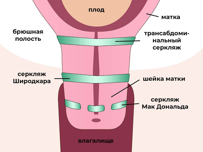 Короткая шейка матки хирургическое лечение