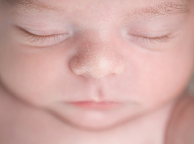 жировики на лице у новорожденного