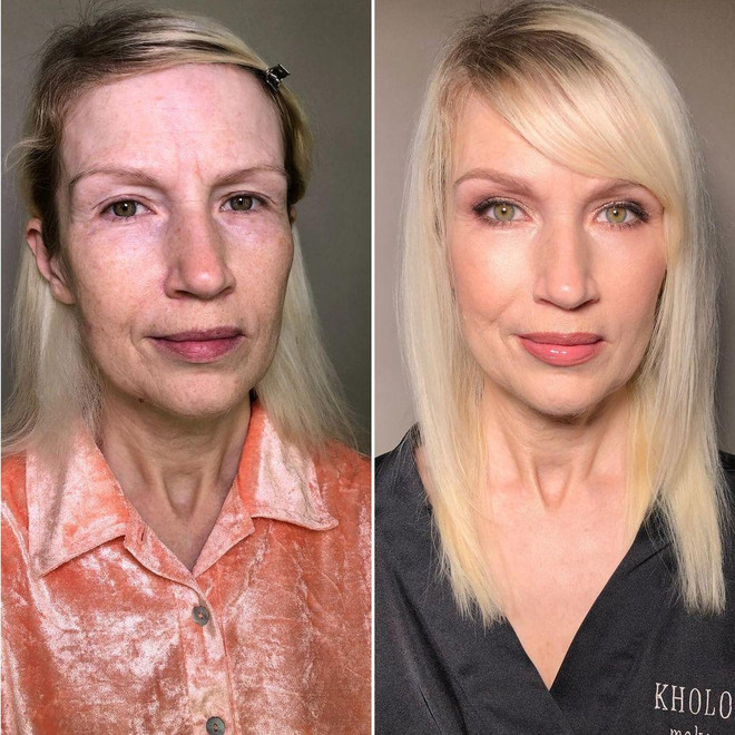 Игольчатый лифтинг лица до и после фото