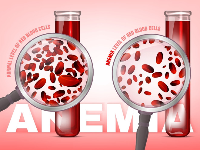 Что такое железодефицитная анемия