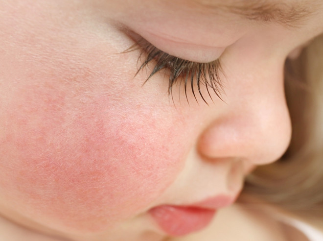 аллергия на холод у ребенка на щеках