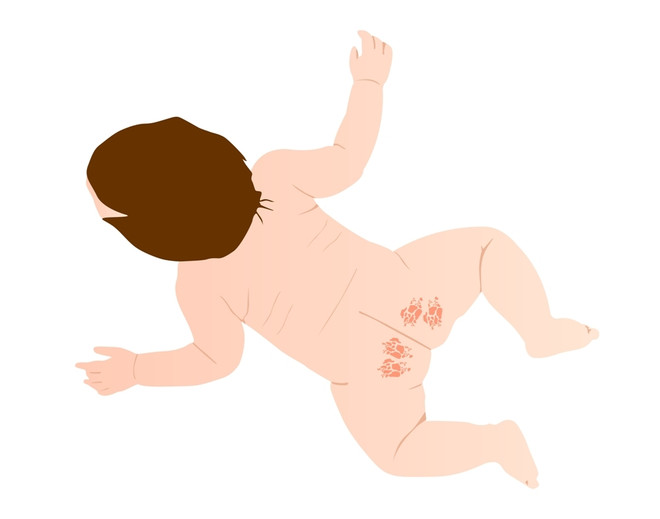 Как отличить аллергическую сыпь от потницы у ребенка?