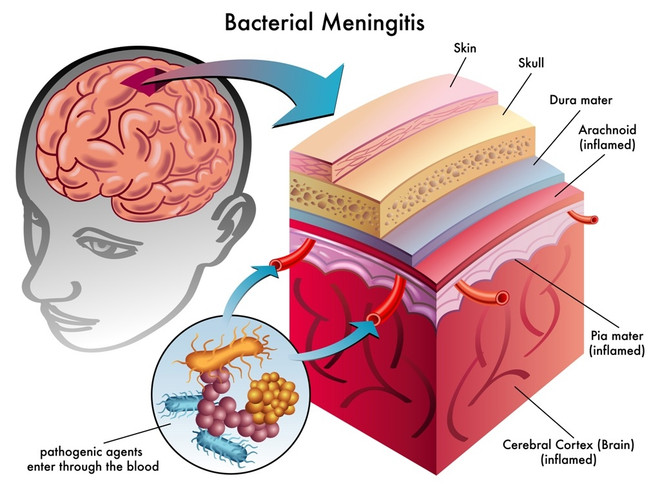 как проявляется менингит