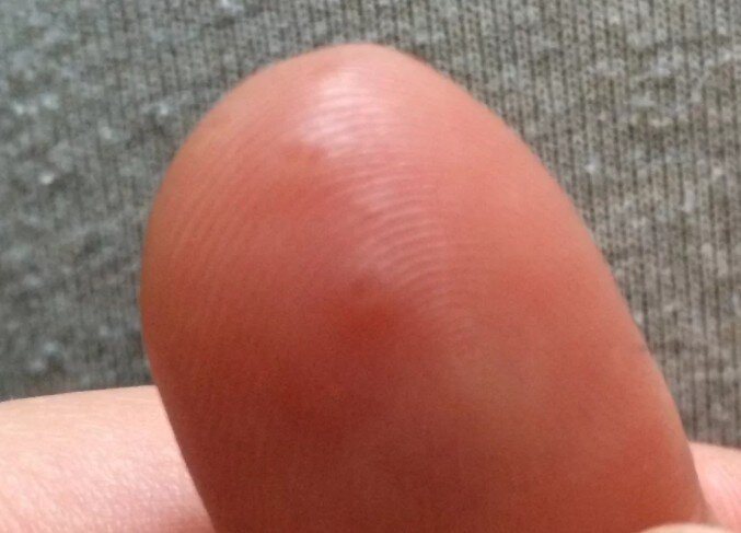 Подкожные прыщи на пальцах рук - аллергия или что-то другое?