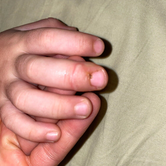 Воспалился палец сыну 2,5 годика