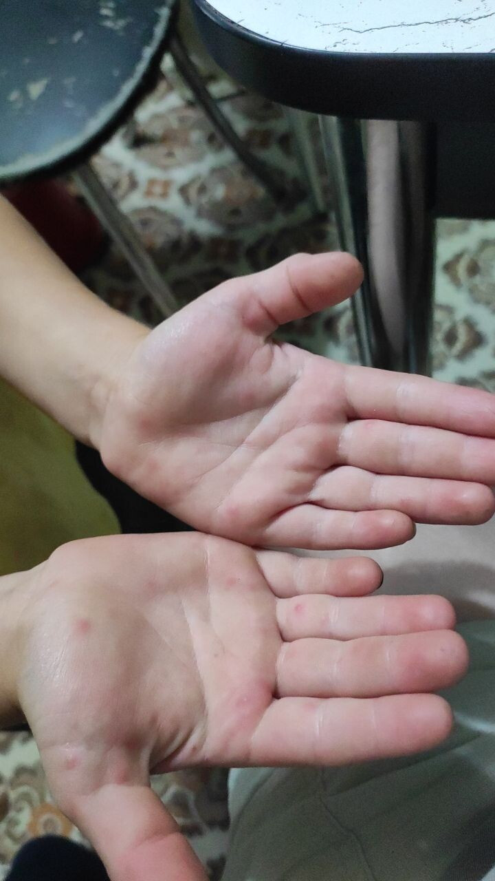 Коксаки?