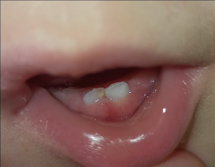 Гиперплазия эмали молочных зубов