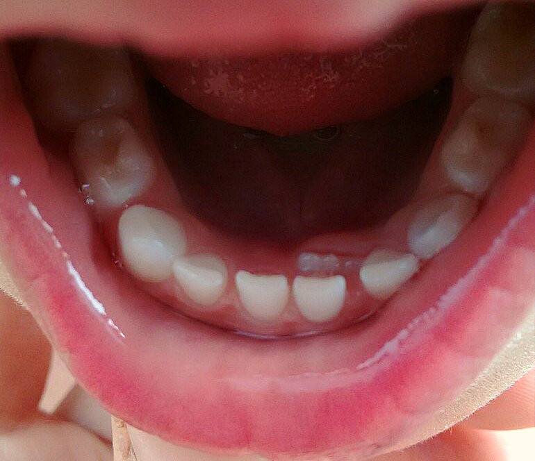 нижние зубы растут вторым рядом