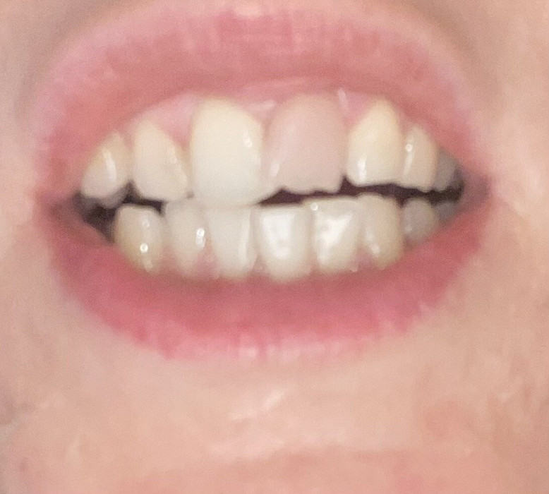 Зуб после ушиба может посветлеть ?