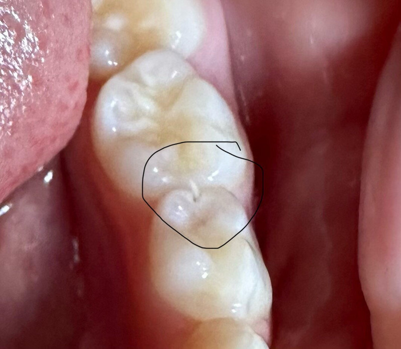 Дырка в зубе