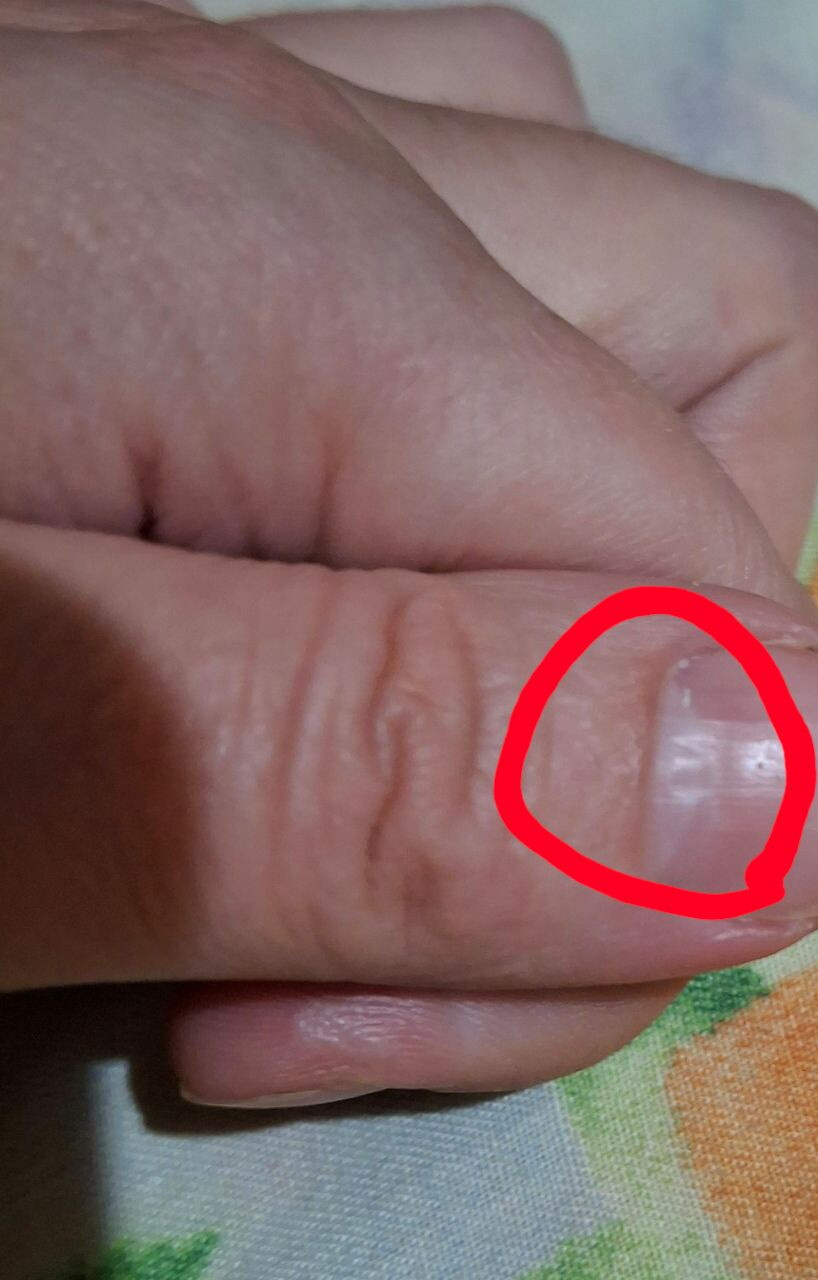 Ямочки на ногтх большого пальца