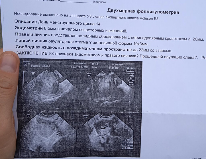 Повторная фоликулометрия