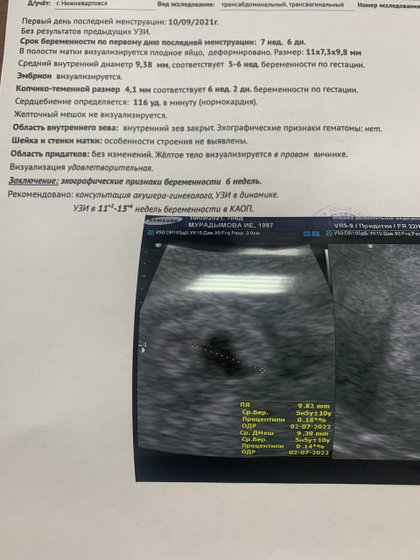 Узи, 7 недель 6 дней все печально