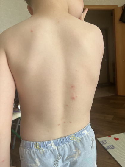 Аллергия у ребёнка
