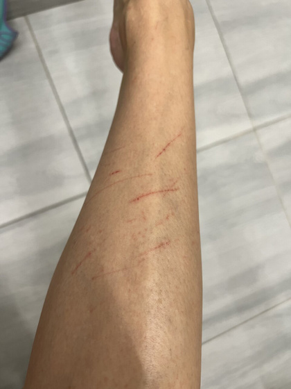 Я пострадала собирая крыжовник😭