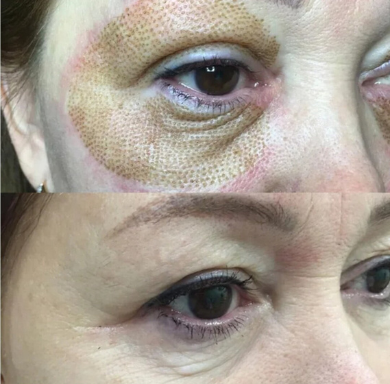 Безоперационная блефаропластика Jett Plasma Lift Medical