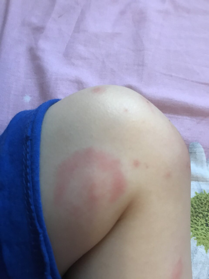 Укусы 🆘