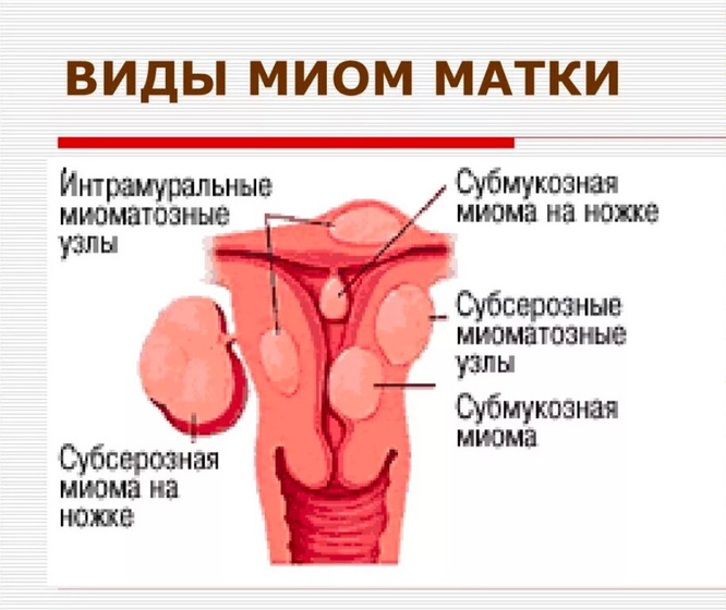 Миома