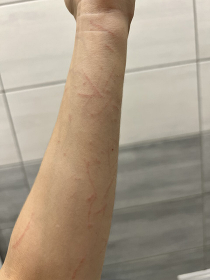 Я пострадала собирая крыжовник😭