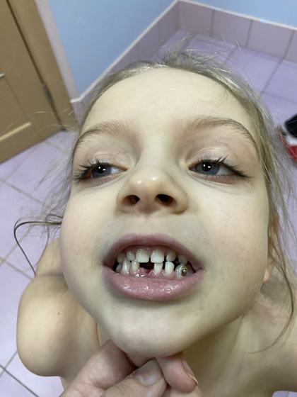 Первый зуб выпал! 🦷
