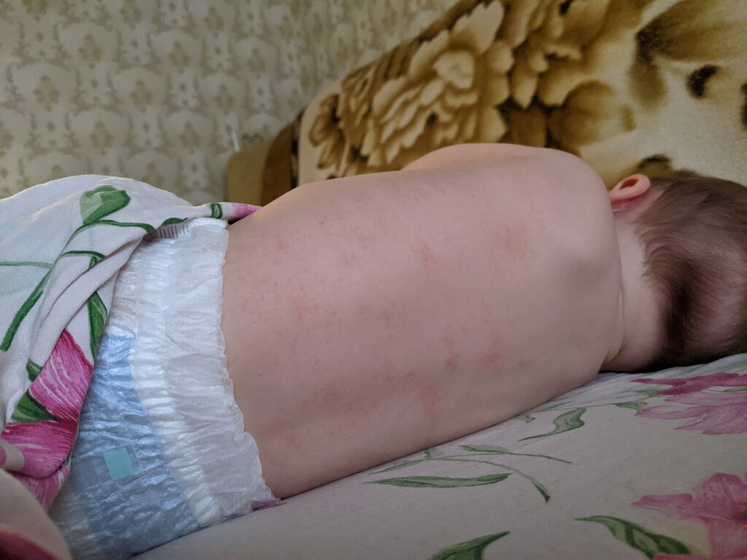 Сыпь, пожалуйста, подскажите срочно!