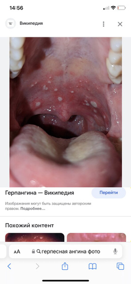 Ангина
