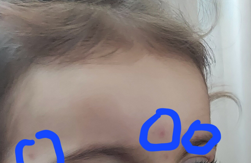 Девочки ветрянку как лечат если это она