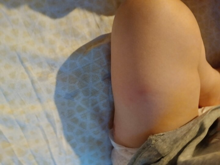 Реакция на полиомелит Это