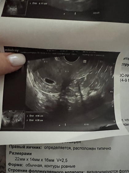 Плодное яйцо и эмбрион узи