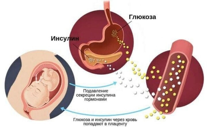 ГСД с инсулином.