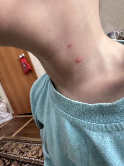 Девочки, дочь переболела ветрянкой