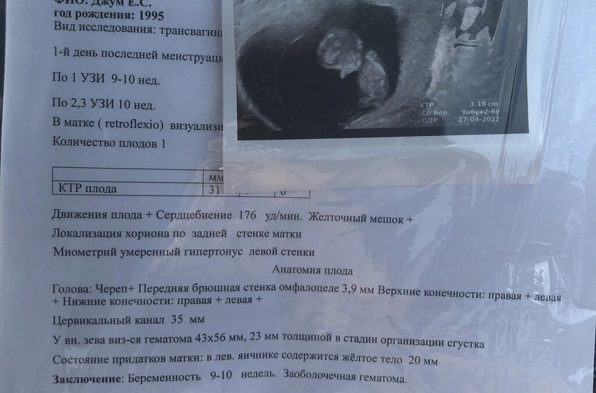 Заоболочечная гематома