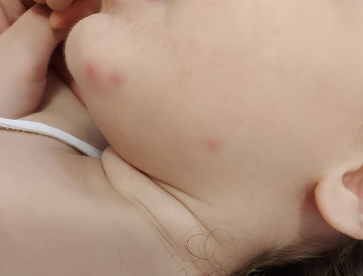 Высыпает уже больше месяца на лице у ребёнка