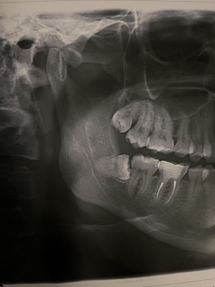 Зубы, отек и боль 🦷