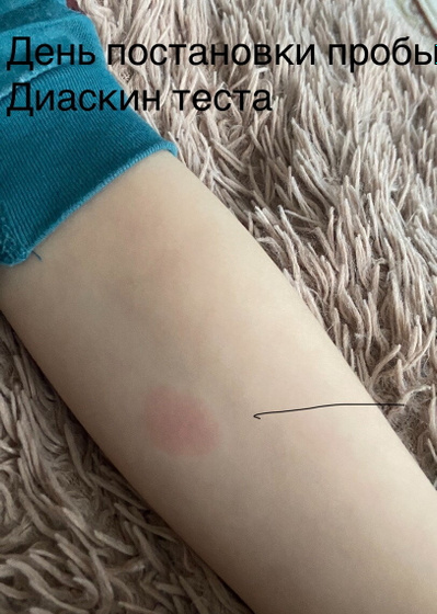Итоги по диаскину .