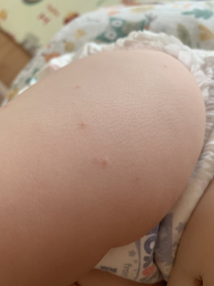 Сыпь на одной ноге