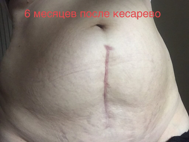 Миома 15см и кесарево в Монииаг