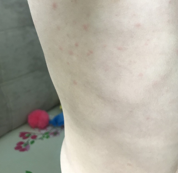 Сыпь. Что это?