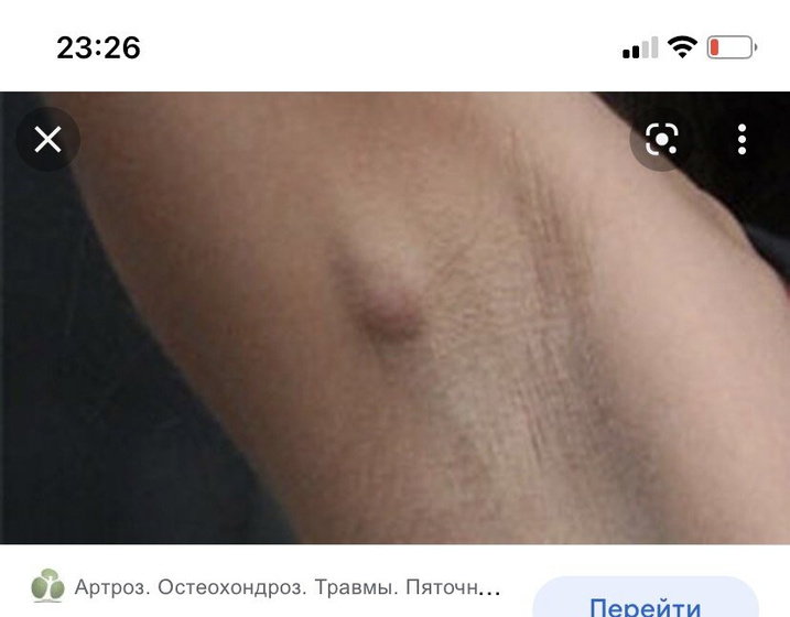 Шишка под мышкой!!😟