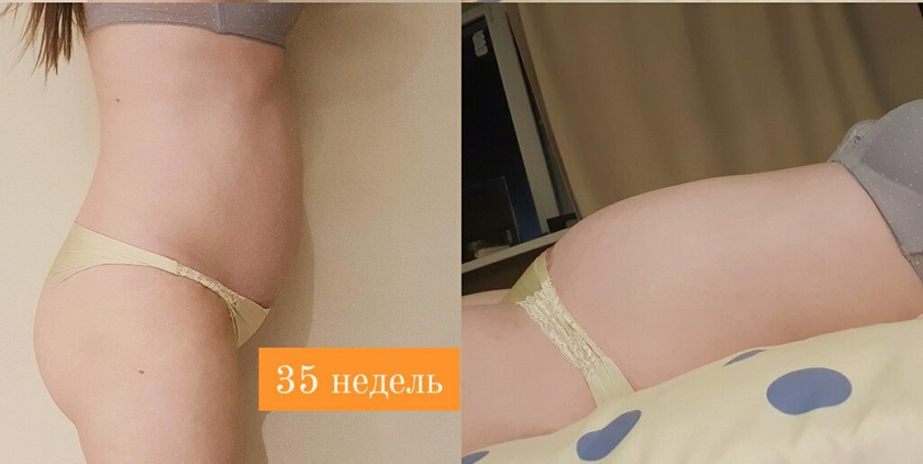 Небольшой живот и многоводие.