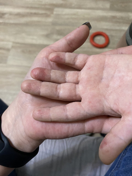 Красные пятна на пальцах
