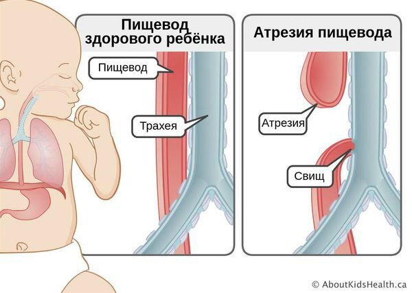 Атрезия пищевода 3