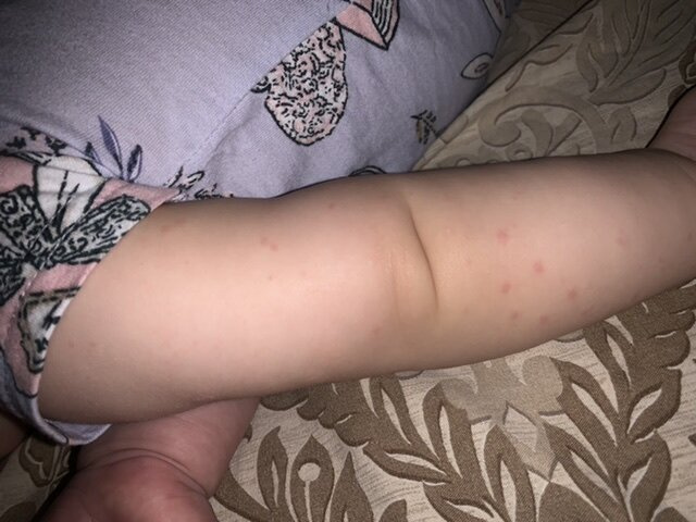 Дочку обсыпало