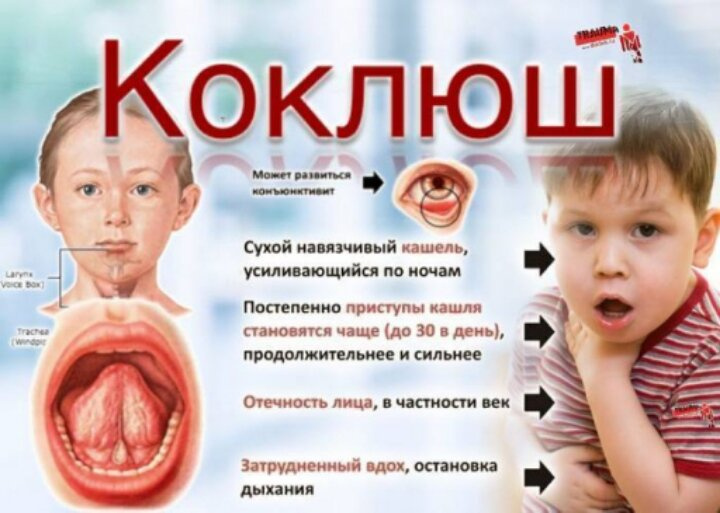 Чем лечили обострённый коклюш?.... Пожалуйста помогите