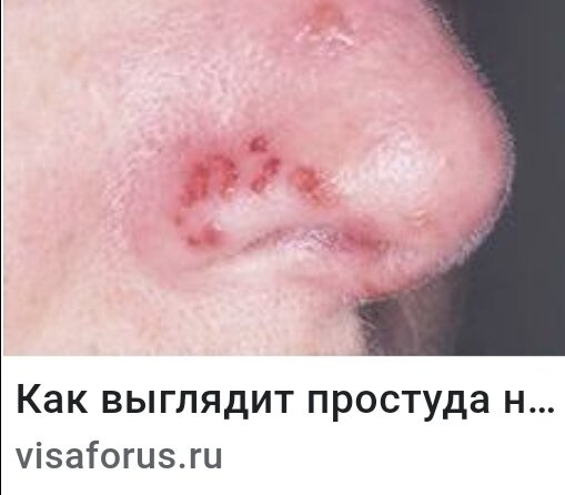 Герпес на носу.