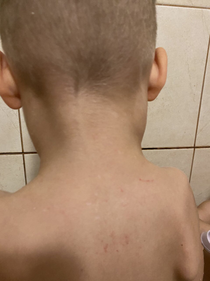 Увеличены лимфоузлы