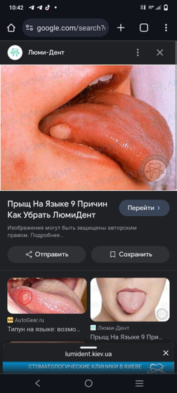 Прыщь на языке