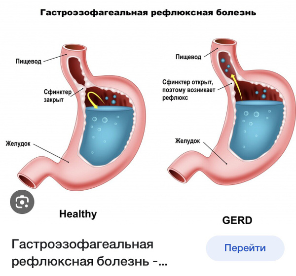 У кого тоже ГЭРБ?( рефлюкс)